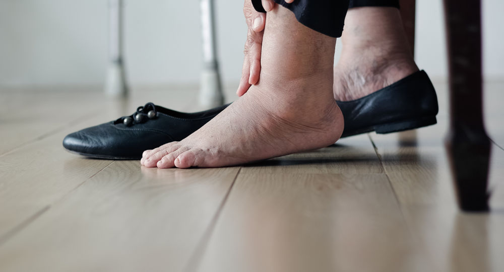 10 علاجات طبيعية تخفف تورم القدمين